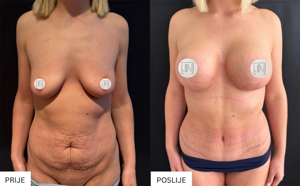 Prije i poslije abdominoplastike – uklanjanje viška kože s trbuha