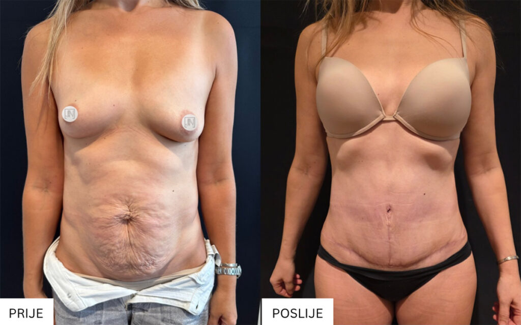 Estetski rezultat oblikovanja trbuha nakon abdominoplastike