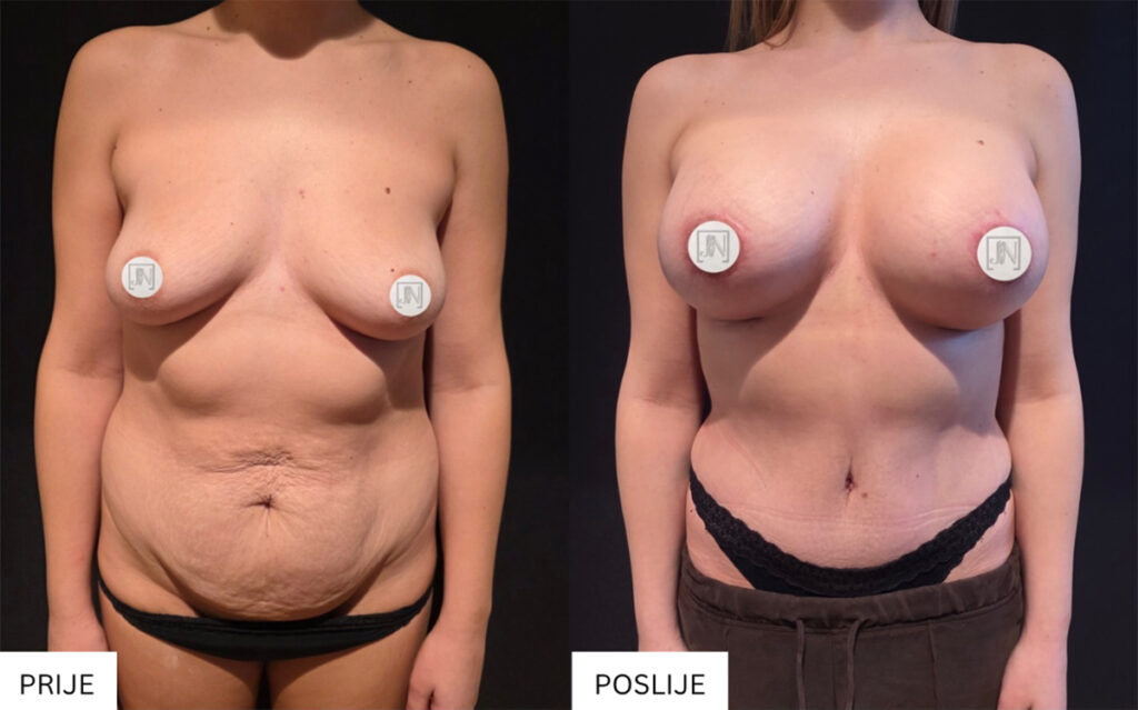 Rezultati abdominoplastike nakon trudnoće i mršavljenja