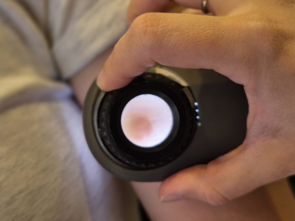 Dermatoskopski pregled madeža izbliza kroz uređaj za analizu kože