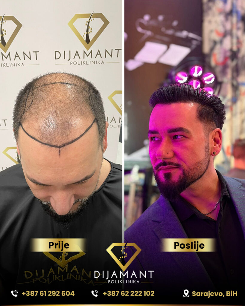 Prije i poslije presađivanja kose 