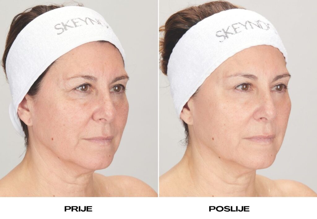 Žena s blistavom i svježom kožom lica nakon neinvazivnog anti-age tretmana