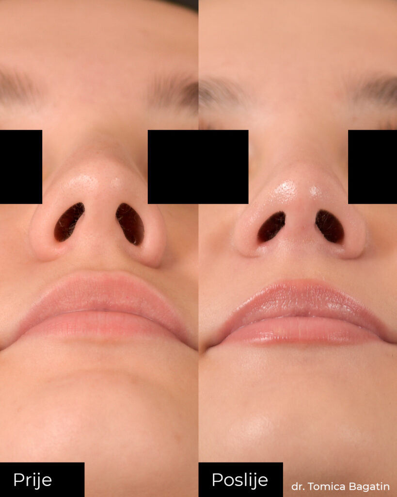 Rinoplastika prije i poslije s prikazom nosnica i baze nosa iz donje perspektive