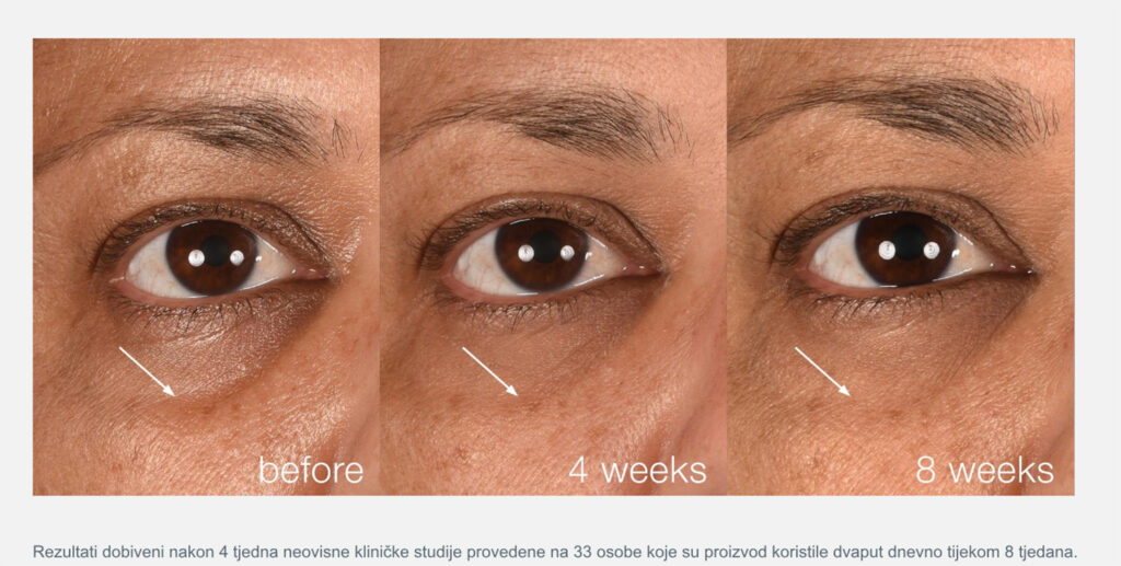Usporedni prikaz okoloočnog područja prije i nakon četiri tjedna korištenja Dermalogica Smart Eye Density seruma